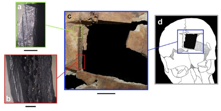 diagramofexcisedbonetrepanationisrael-23065952.jpg